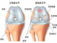 且行且珍“膝”：关注膝关节炎