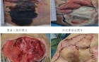 多学科协作治愈大面积不可分期压力性损伤纪实
