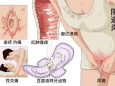 霉菌性阴道炎总是反反复复怎么办