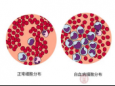 白细胞正常可以排除白血病吗？