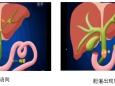 经皮肝穿刺胆管引流术（PTCD）