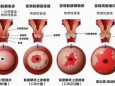 HPV可怕吗？让感染HPV不再闻风丧胆