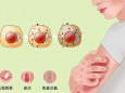 放射性皮肤损伤，我们应如何应对？