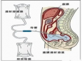 啥是腹膜透析？