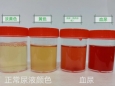 尿液变红莫惊慌，血尿常识需知晓