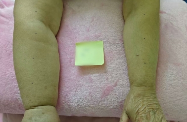 守护“生命之流”——淋巴水肿的综合诊疗与人文关怀