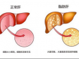 脂肪肝“找上门”别大意，瘦子、吃素的人也可能中招！